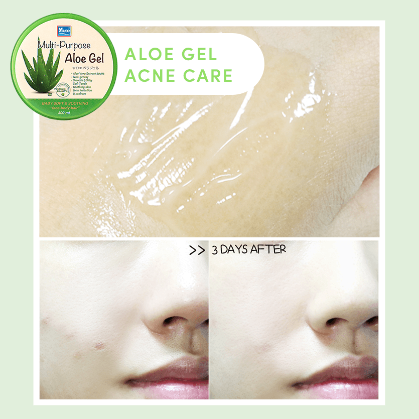 Yoko Multi-Purpose Aloe Gel  เจลอะโลเวร่า ช่วยสมานผิวและกักเก็บความชุ่มชื่นในผิว ทำให้ผิวเนียนใส และดูอ่อนกว่าวัย ลดการอักเสบของสิว